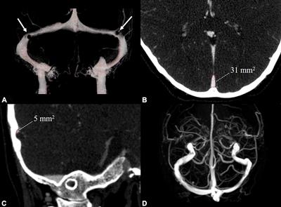 Transverse Sinus Stenosis in Venous Pulsatile Tinnitus Patients May Lead to Brain Perfusion and White Matter Changes